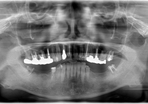 40代男性　歯のないところにインプラントを入れたいの治療前
