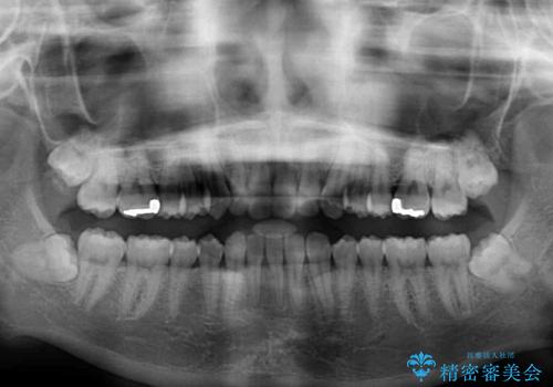 インビザラインによる出っ歯とすきっ歯の改善の治療後