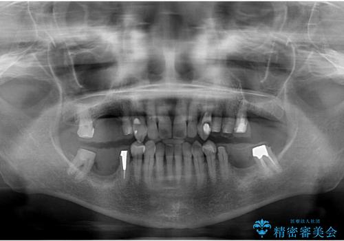咬み合わせが悪くて奥歯が抜歯に　矯正治療と奥歯のセラミックブリッジの治療中
