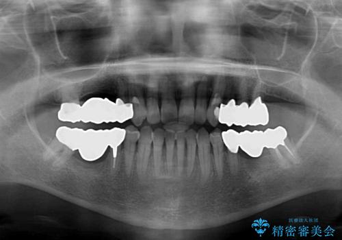 咬み合わせが悪くて奥歯が抜歯に　矯正治療と奥歯のセラミックブリッジの治療後