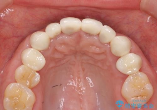 [歯ぐきからの出血]　歯肉の状態を改善する前歯オールセラミック治療②の治療後