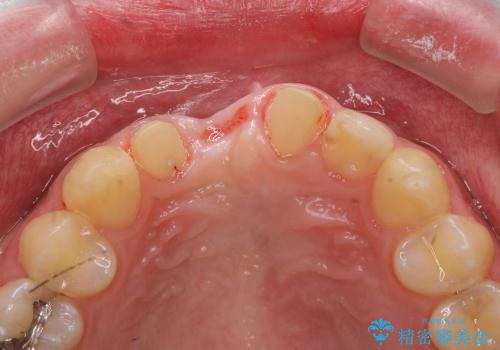 [歯槽堤保存術を併用したブリッジの作製]　可能な限り歯ぐきの厚みを保存し審美的にの治療後