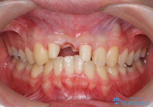 [歯の破折] 歯槽堤保存術を応用した前歯部セラミック治療の治療中