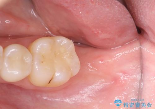 [straumann implant] 薄くなった歯牙の破折　インプラントによる咬合回復の治療前