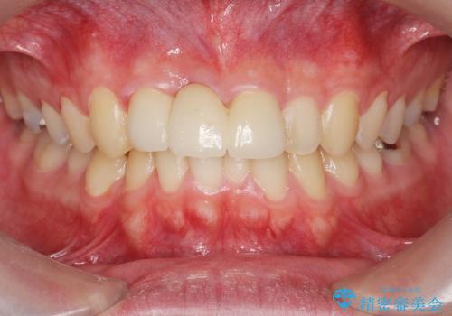 [歯の破折] 歯槽堤保存術を応用した前歯部セラミック治療の治療後