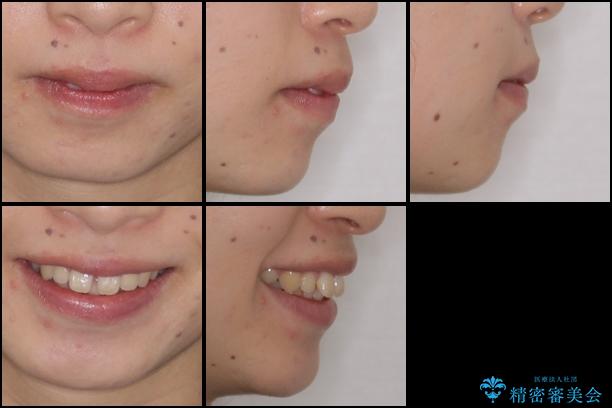 インビザラインによる出っ歯とすきっ歯の改善の治療前（顔貌）