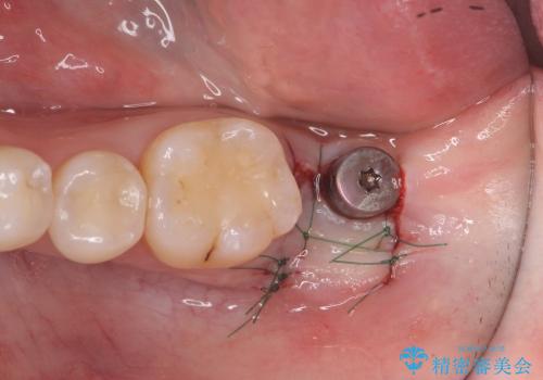 [straumann implant] 薄くなった歯牙の破折　インプラントによる咬合回復の治療中