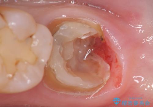 [straumann implant] 薄くなった歯牙の破折　インプラントによる咬合回復の治療前