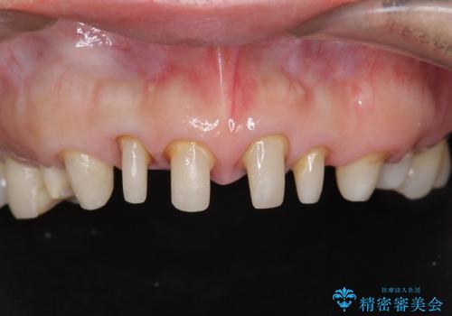 [歯ぐきからの出血]　歯肉の状態を改善する前歯オールセラミック治療②の治療中