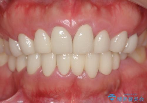 [歯ぐきからの出血]　歯肉の状態を改善する前歯オールセラミック治療②の治療前