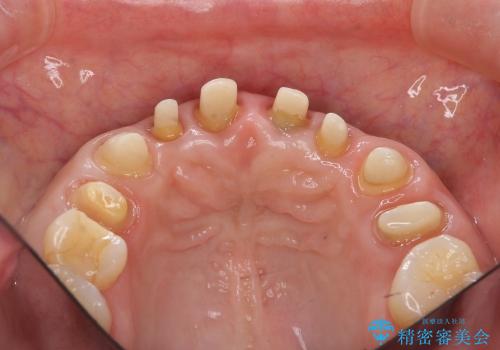 [歯ぐきからの出血]　歯肉の状態を改善する前歯オールセラミック治療①の治療後