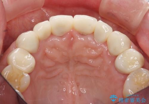 [歯ぐきからの出血]　歯肉の状態を改善する前歯オールセラミック治療②の治療後
