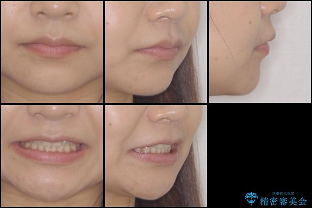 インビザラインによる前歯のでこぼこ改善の治療後（顔貌）