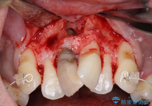 静脈内鎮静下で行う矯正治療の妨げとなる正中過剰埋伏抜歯の治療中