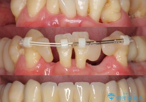 小矯正を併用し歯の神経を残す歯周病治療・下顎前歯メタルボンドブリッジの作製①