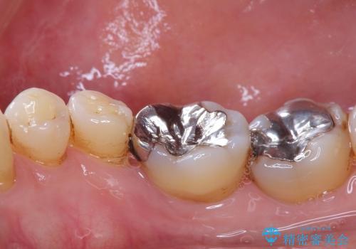 [歯周病治療] インプラント・ブリッジによる咬合機能回復の治療前