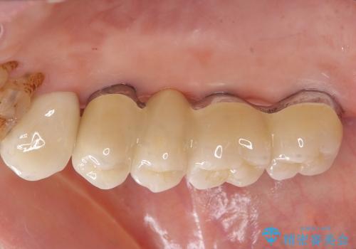 [歯周病治療] インプラント・ブリッジによる咬合機能回復の治療後