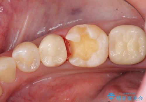 銀歯を白く　セラミックインレー修復の治療中