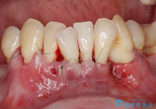 小矯正を併用し歯の神経を残す歯周病治療・下顎前歯メタルボンドブリッジの作製①の治療中