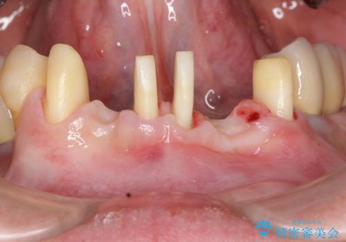 小矯正を併用し歯の神経を残す歯周病治療・下顎前歯メタルボンドブリッジの作製②の治療中