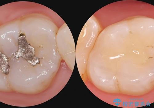 水銀を含む環境汚染金属アマルガムの除去 奥歯のセラミックインレー修復