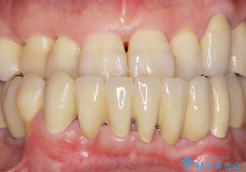 小矯正を併用し歯の神経を残す歯周病治療・下顎前歯メタルボンドブリッジの作製②の治療後
