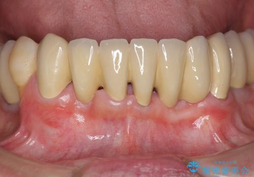 小矯正を併用し歯の神経を残す歯周病治療・下顎前歯メタルボンドブリッジの作製②の治療後