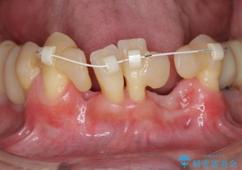 小矯正を併用し歯の神経を残す歯周病治療・下顎前歯メタルボンドブリッジの作製①の治療後