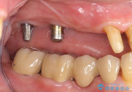 [歯周病治療] インプラント・ブリッジによる咬合機能回復の治療中