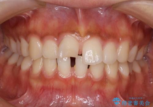 抜かない矯正　すきっ歯　前歯が欠けた　右上奥歯を後ろに下げて治療の治療前