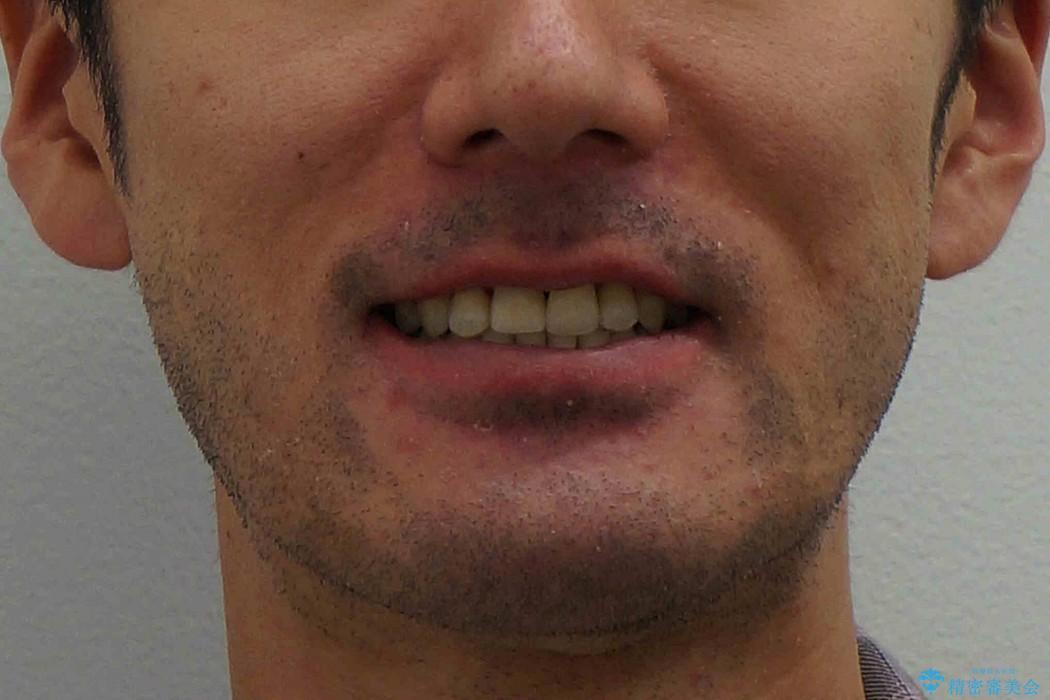 前歯の劇的な変化　前歯の著しいガタつき、変色の治療後（顔貌）
