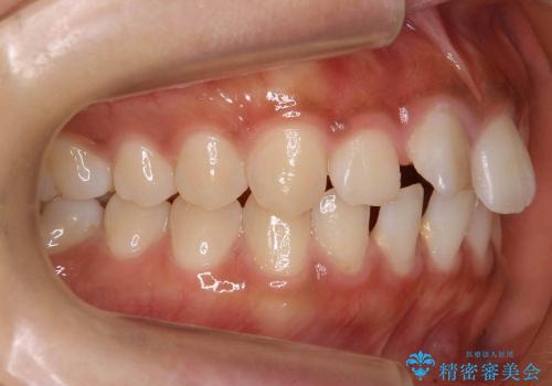抜かない矯正　すきっ歯　前歯が欠けた　右上奥歯を後ろに下げて治療の治療前