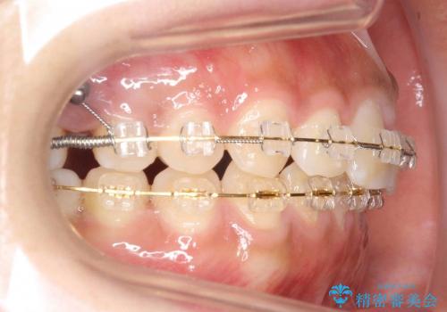 抜かない矯正　すきっ歯　前歯が欠けた　右上奥歯を後ろに下げて治療の治療中