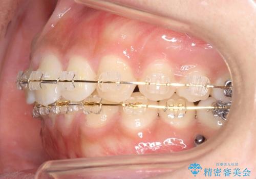 抜かない矯正　すきっ歯　前歯が欠けた　右上奥歯を後ろに下げて治療の治療中