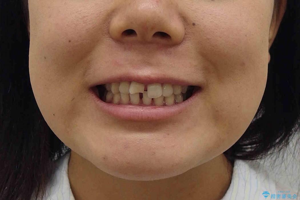 抜かない矯正　すきっ歯　前歯が欠けた　右上奥歯を後ろに下げて治療の治療前（顔貌）