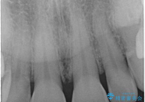 前歯の破折→オールセラミックによる審美性の回復の治療前