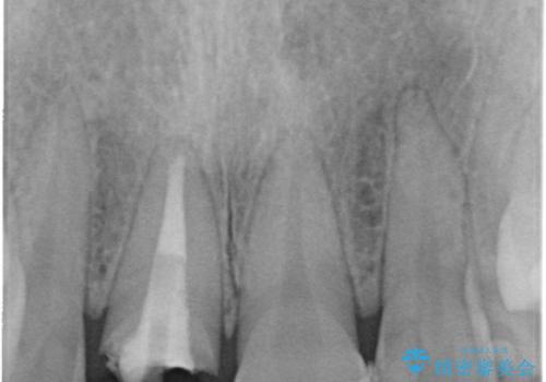 前歯の破折→前歯のセラミック治療(土台ごとやり変え)の治療前