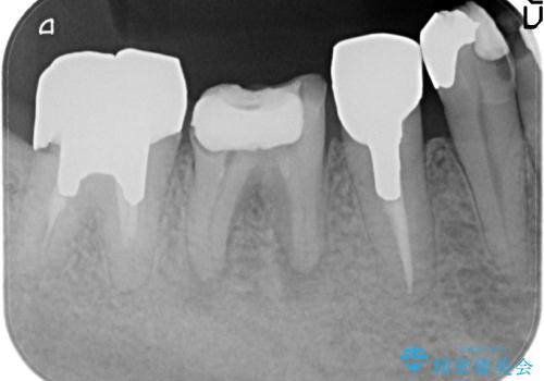 5根管(近心に3根管)を持つ下顎第1大臼歯へのイニシャルトリートメントの治療前