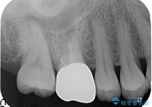 銀歯を白いきれいな歯への治療前