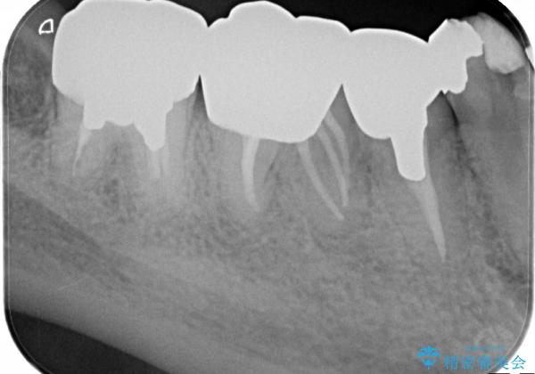 5根管(近心に3根管)を持つ下顎第1大臼歯へのイニシャルトリートメント