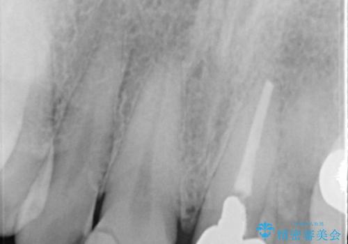 50代男性　前歯の審美ブリッジ　骨の厚みを保存した抜歯の治療前
