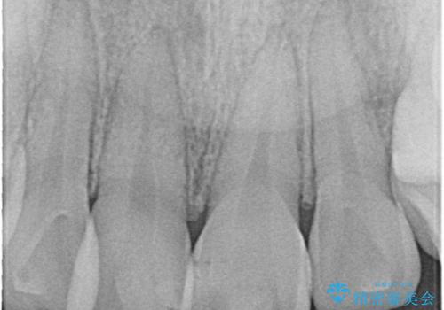 正中過剰埋伏歯の抜歯の治療後