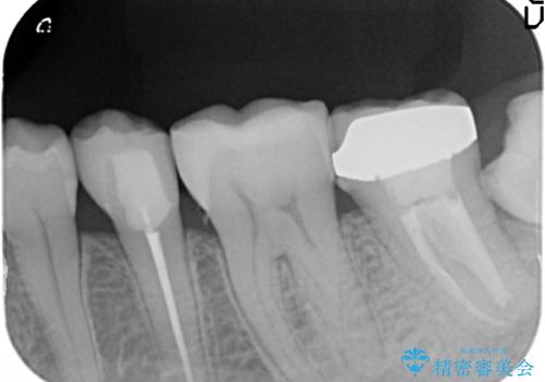 銀歯を白く　セラミックインレー修復の治療後