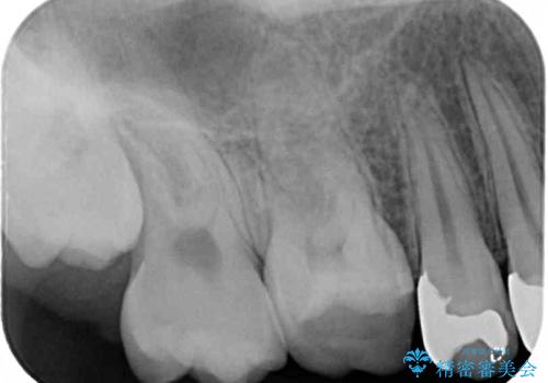 何回通院しても痛みが引かない　奥歯の根管治療の治療前