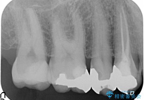 歯が欠けて大きな穴に　セラミックインレー修復の治療後