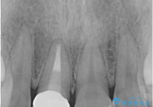 前歯の破折→前歯のセラミック治療(土台ごとやり変え)の治療後