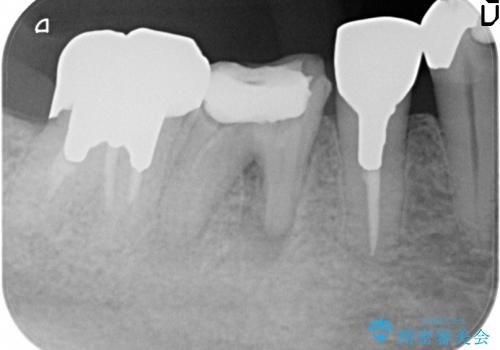 5根管(近心に3根管)を持つ下顎第1大臼歯へのイニシャルトリートメントの治療前