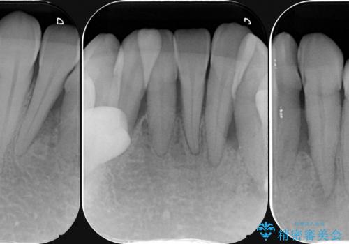 小矯正を併用し歯の神経を残す歯周病治療・下顎前歯メタルボンドブリッジの作製①の治療前