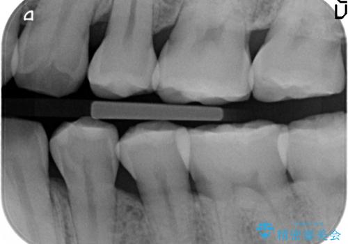 セラミックインレーによる早期虫歯治療の治療前