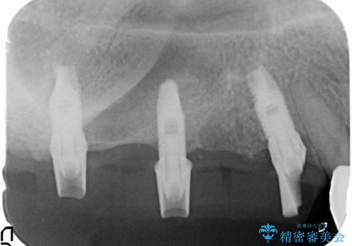 [歯周病治療] インプラント・ブリッジによる咬合機能回復の治療中